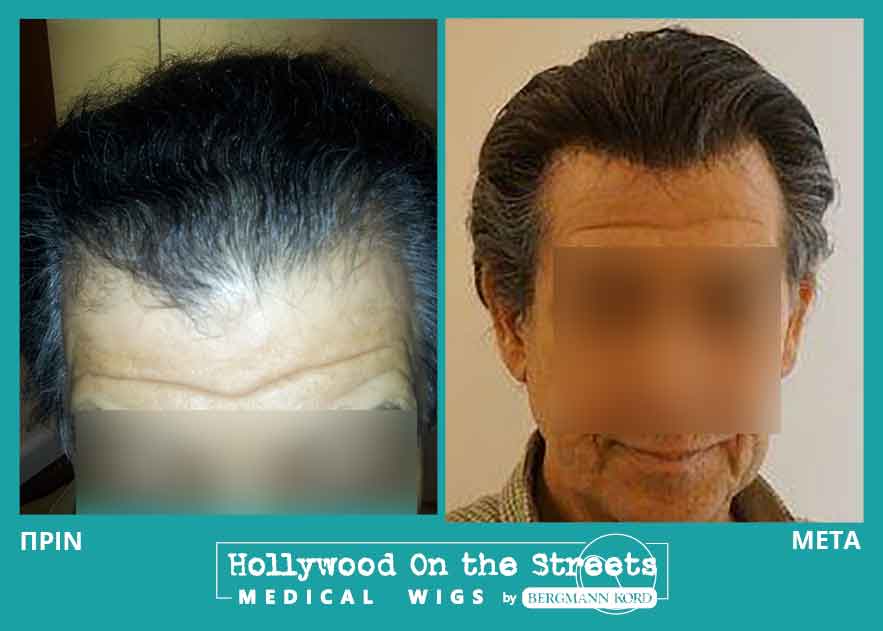 hair-system-hos-wigs-results-men-023762PG-001