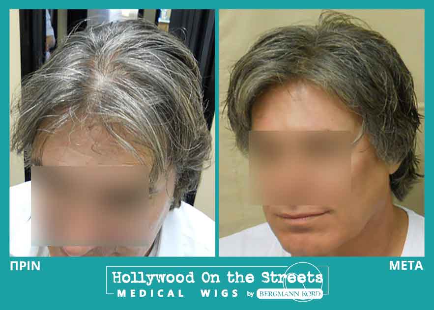 hair-system-hos-wigs-results-men-030158PG-001