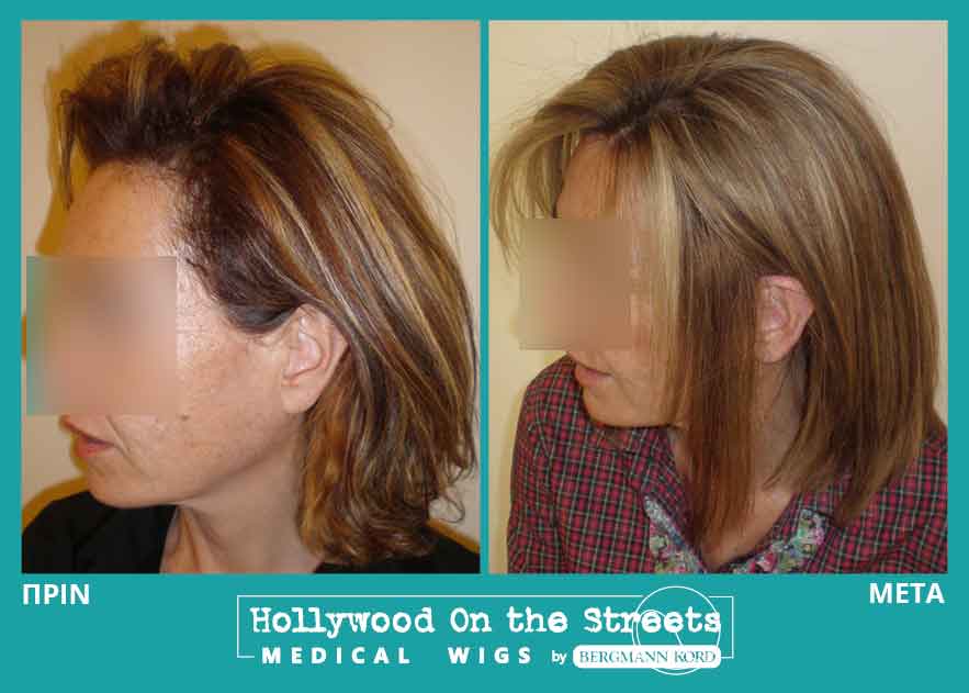 hair-system-hos-wigs-results-women-026777PG-001