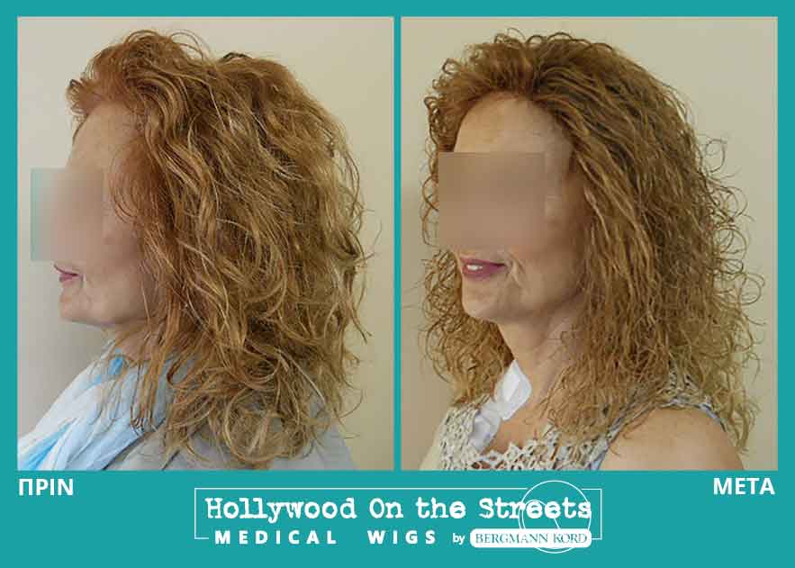 hair-system-hos-wigs-results-women-027002PG-001