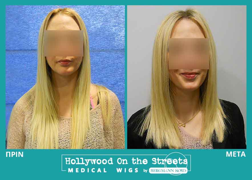 hair-system-hos-wigs-results-women-028200PG-001