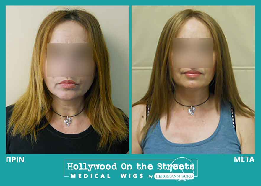 hair-system-hos-wigs-results-women-028941PG-001