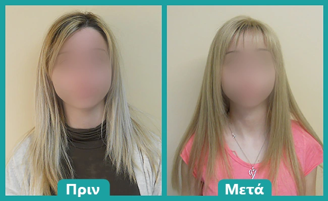 Περούκα χημειοθεραπείας