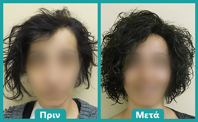 Περούκα αποτέλεσμα σε γυναίκα