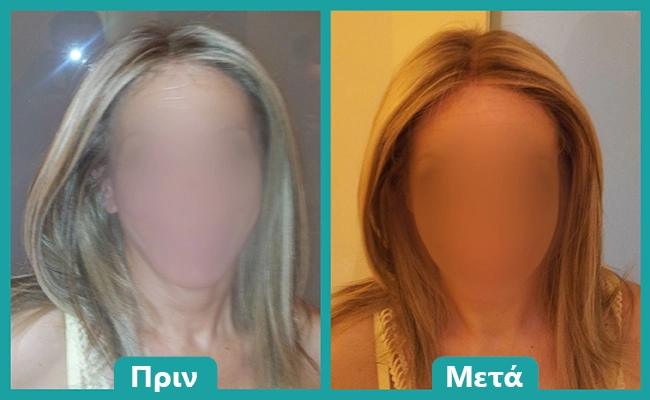 Περούκα χημειοθεραπείας αποτέλεσμα